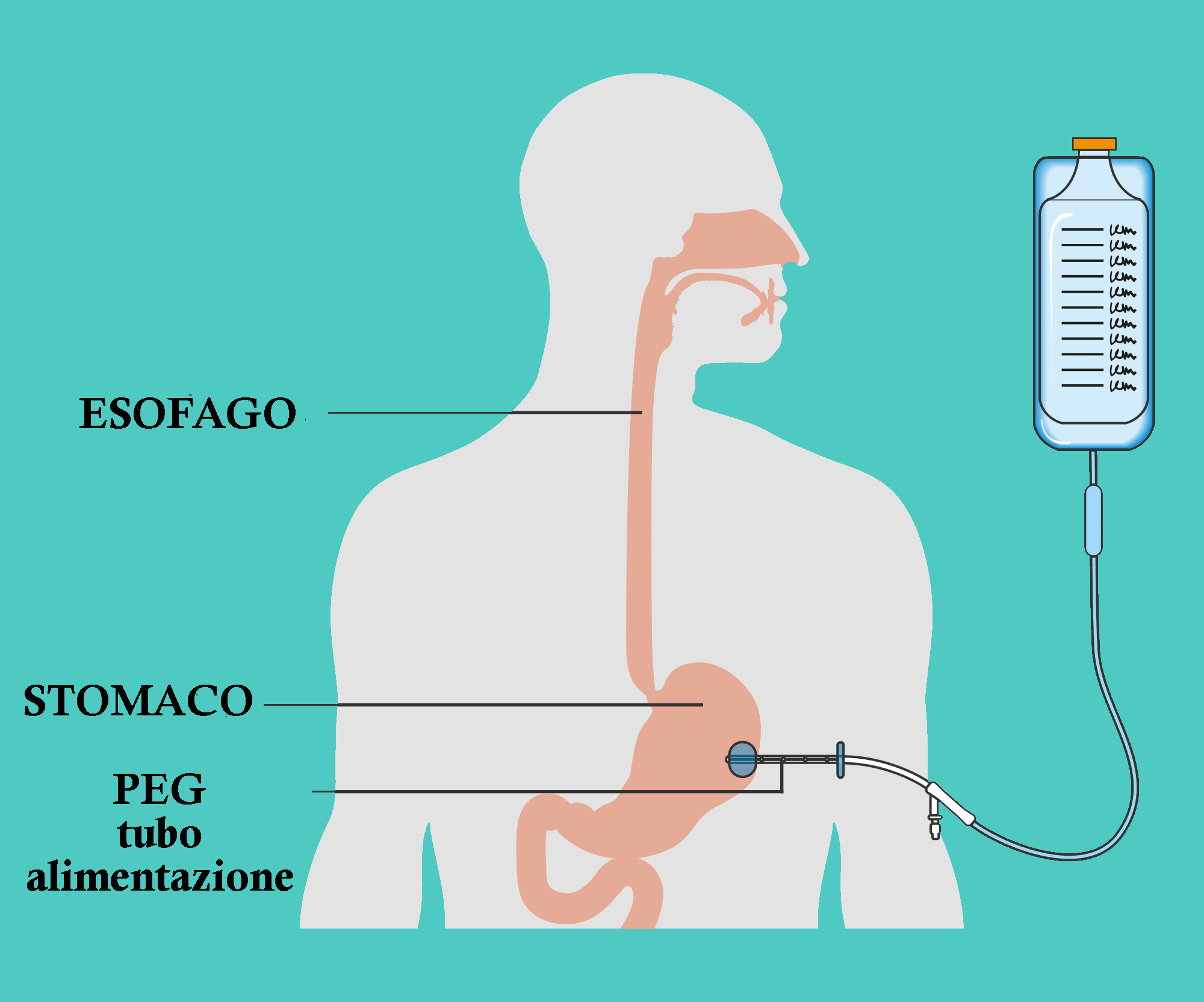 Alimentazione Via Peg Alimentazione Con PEG Guida Completa E 